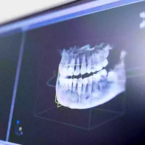 Mouth Cancer Staging